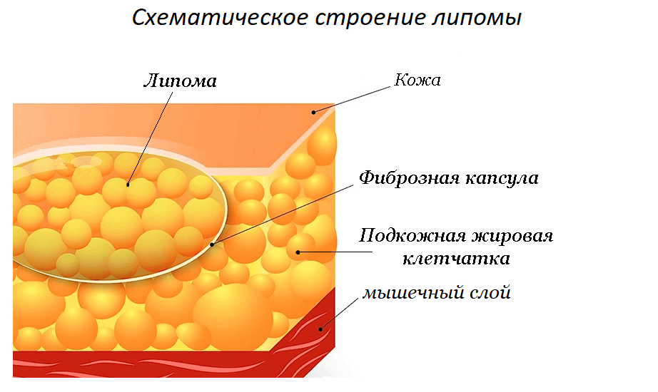 строение липомы строение липомы