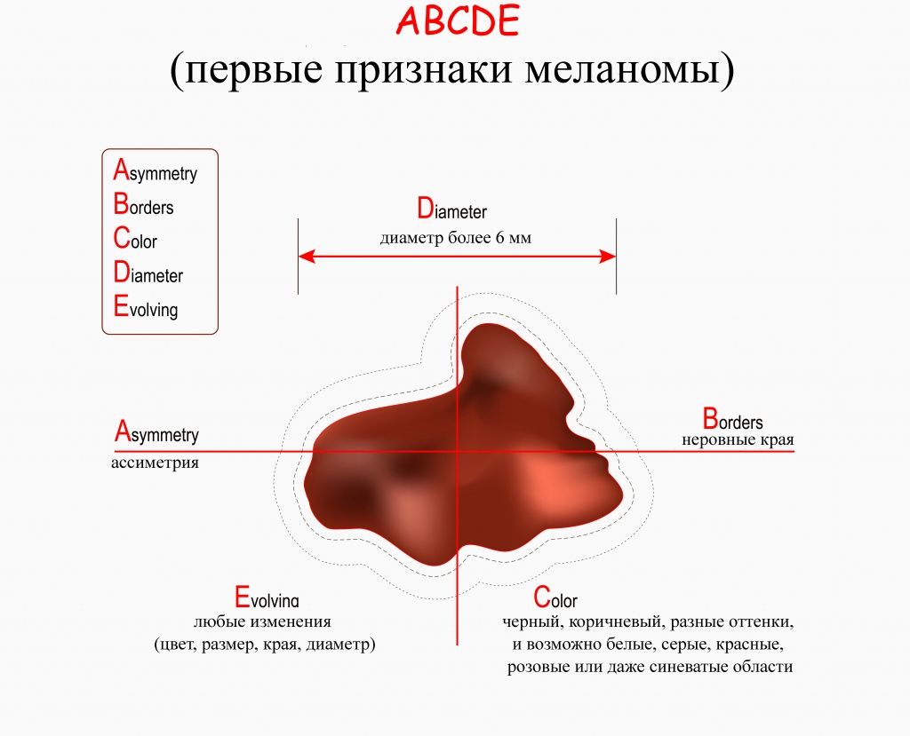 АВСDE признаки меланомы АВСDE признаки меланомы