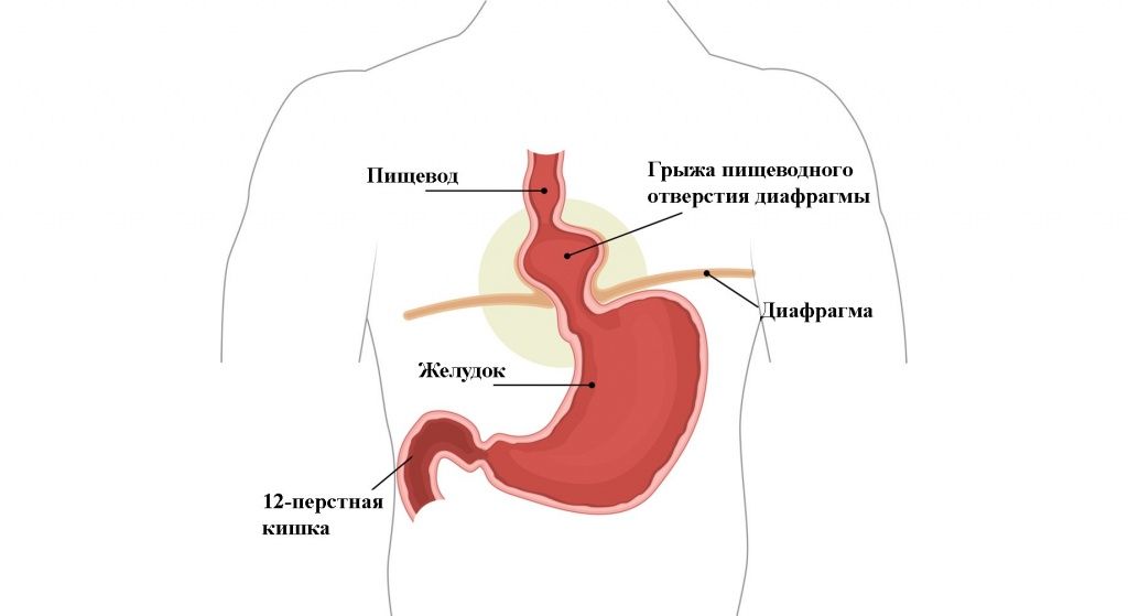 Грыжа.jpg