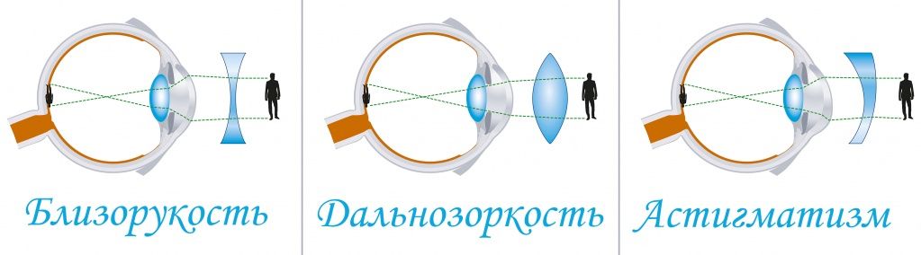 Способы коррекции зрения.jpg