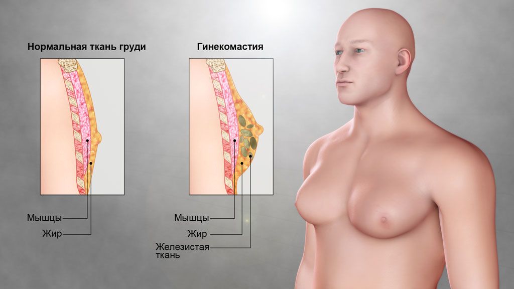 Гинекомастия