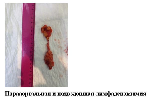 Парааортальная и подвздошная лимфаденэктомия 15.jpg