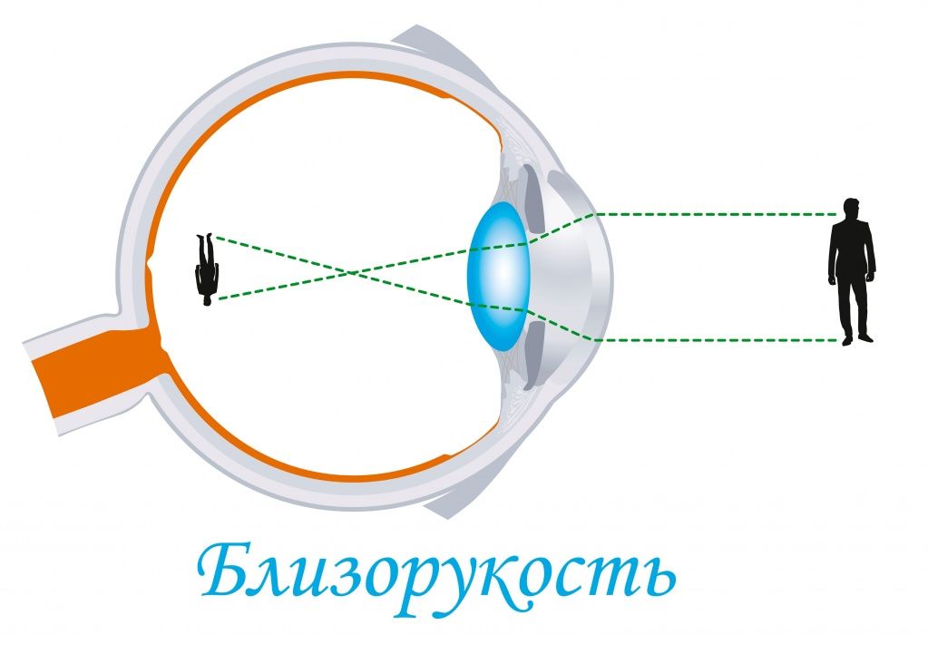 Близорукость.jpg