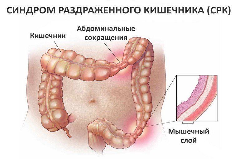 Синдром раздраженного кишечника Синдром раздраженного кишечника