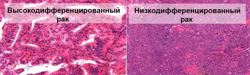 Дифференциализация рака Дифференциализация рака