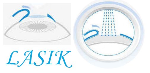 LASIK.jpg