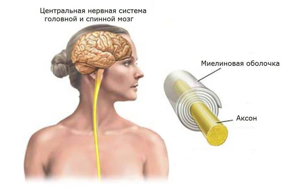 Рассеянный склероз у женщин