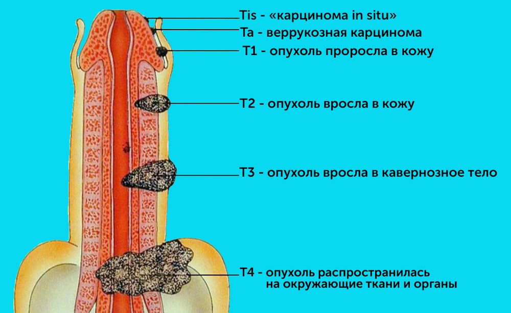 Стадии рака полового члена