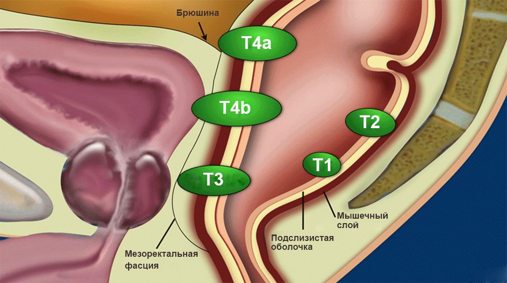 Что такое классификация 1, 2, 3 и 4 стадий рака прямой кишки по ТНМ? Чем они отличаются и как расшифровать свой диагноз? Что такое классификация 1, 2, 3 и 4 стадий рака прямой кишки по ТНМ? Чем они отличаются и как расшифровать свой диагноз?