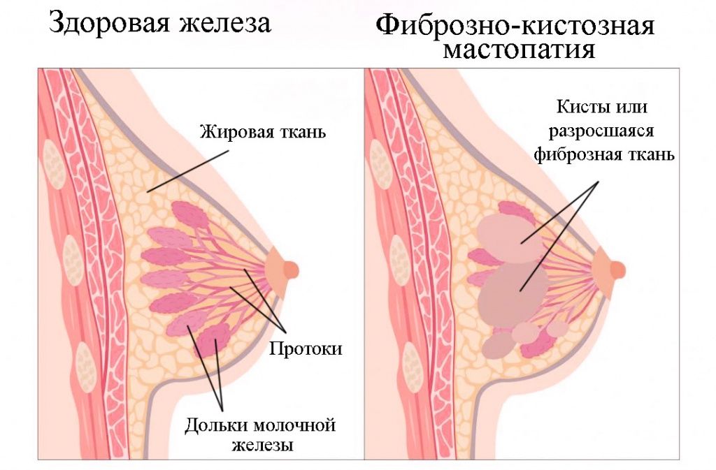 Мастопатия.jpg Мастопатия.jpg