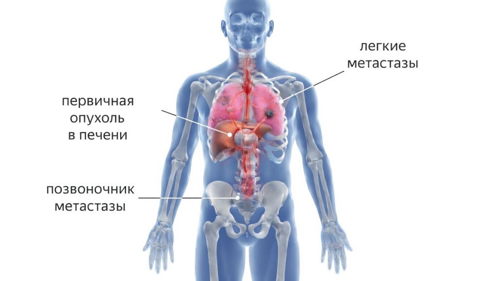 метастазы печени.jpeg