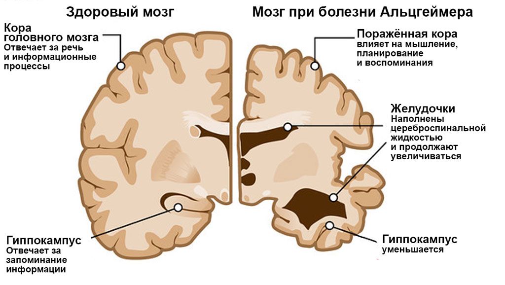 Мозг при болезни Альцгеймера Мозг при болезни Альцгеймера