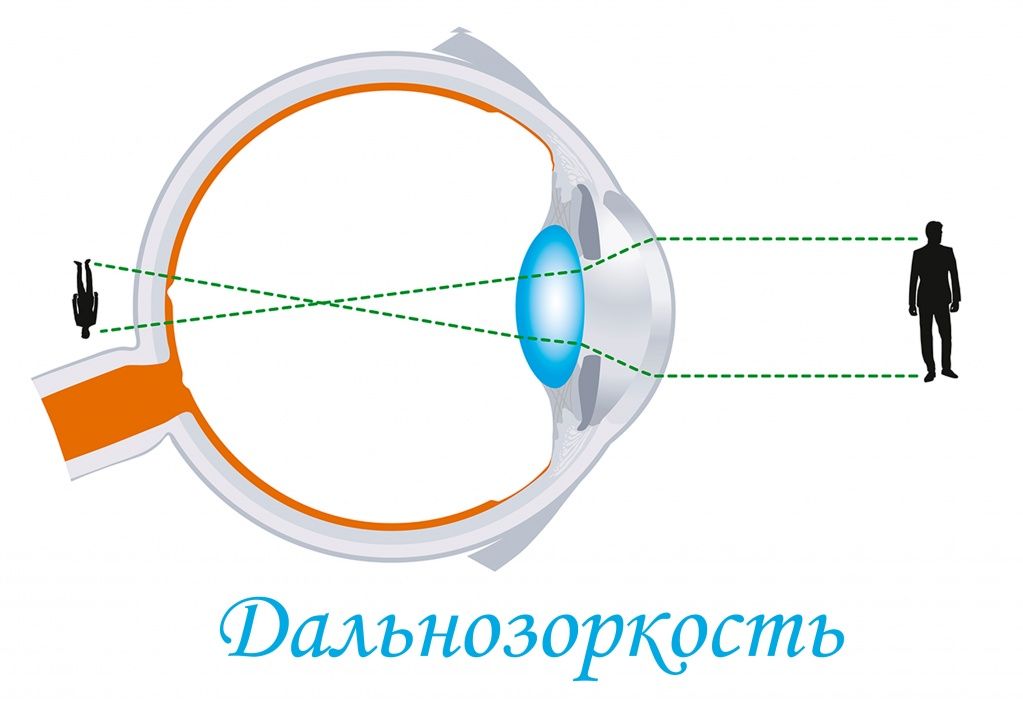 Дальнозоркость.jpg
