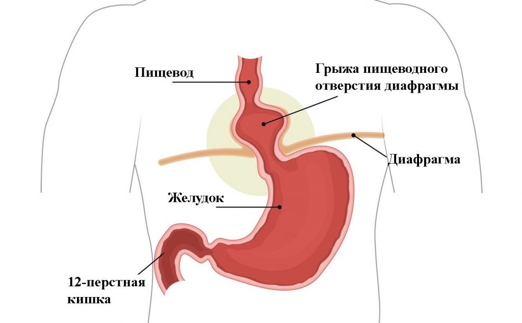 Грыжа1.jpg