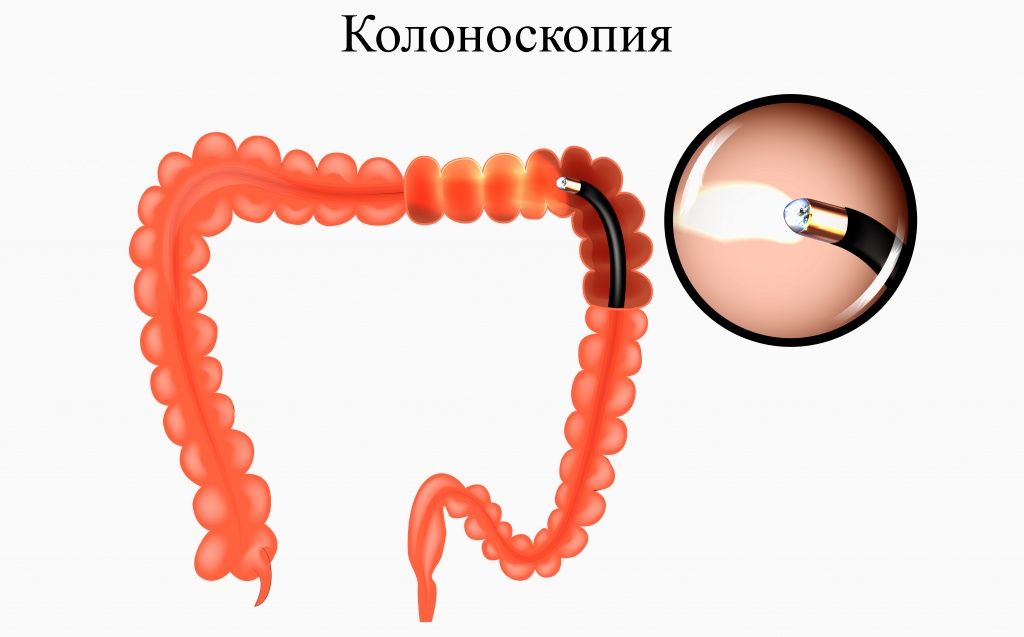 Колоноскопия