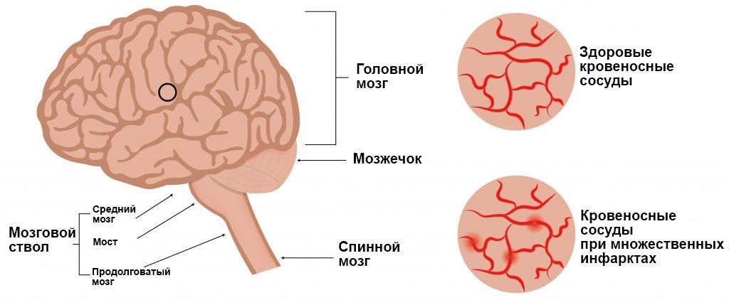 Головной мозг при сосудистой деменции Головной мозг при сосудистой деменции