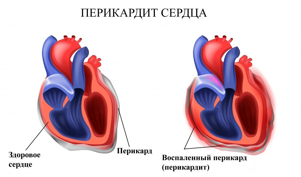 перикардит.jpg
