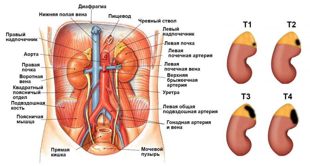 Рак надпочечника