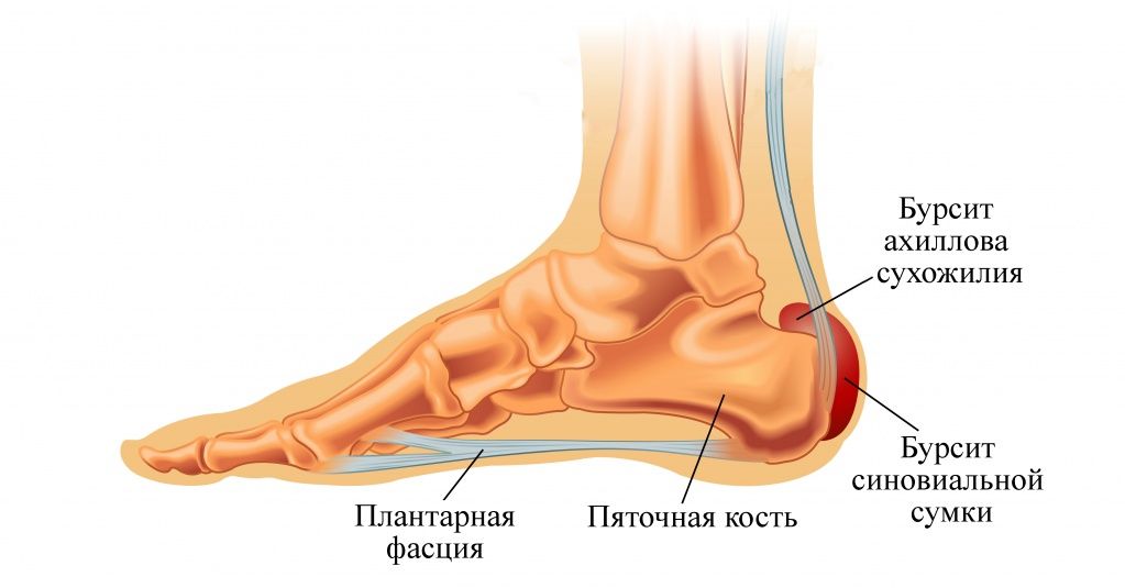 Бурсит