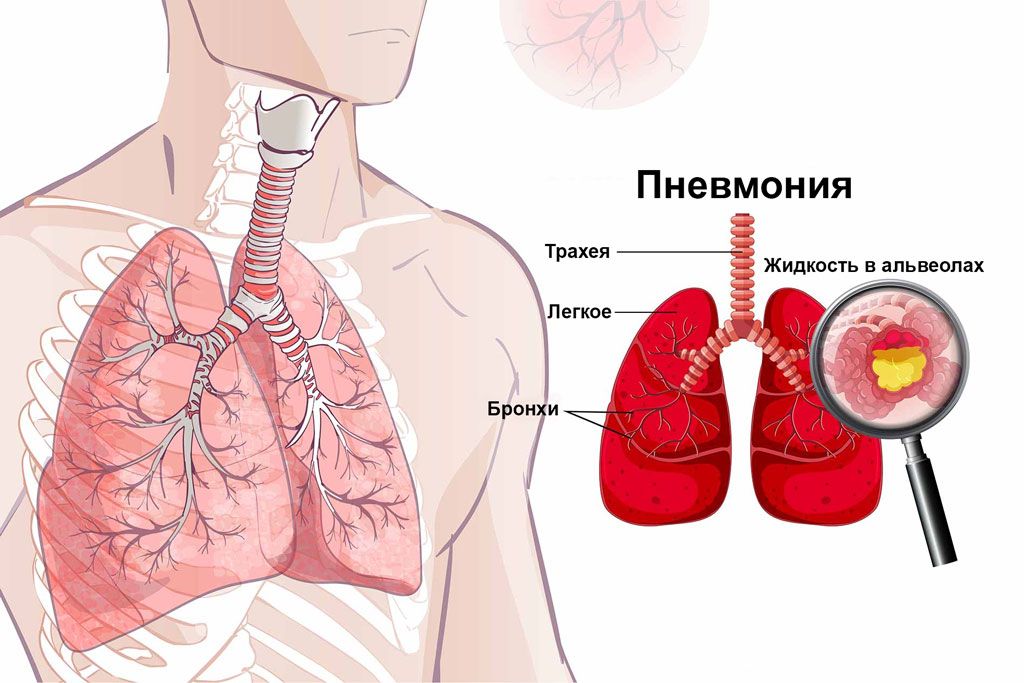 Пневмония при COVID Пневмония при COVID