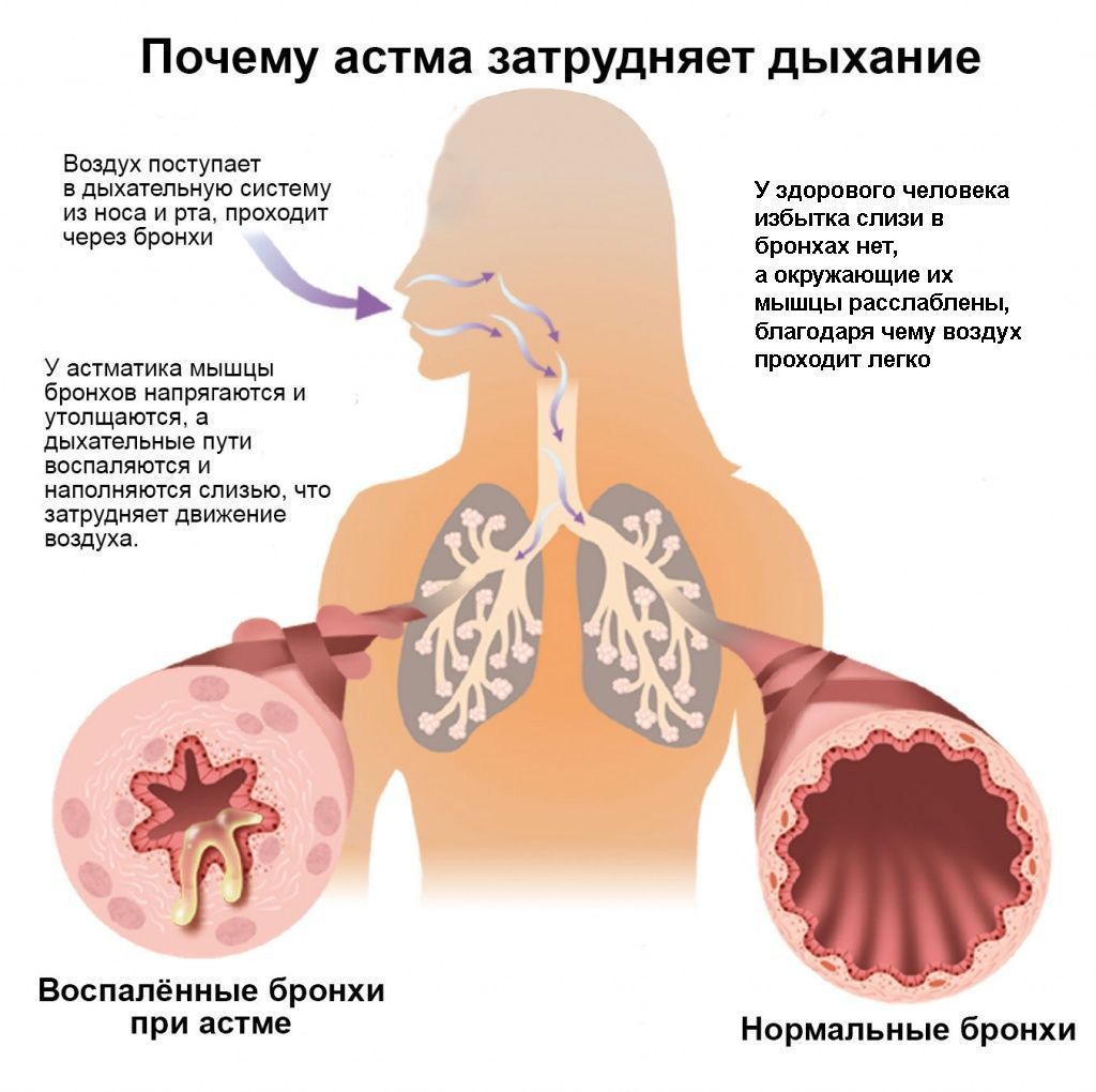 Почему затруднено дыхание при астме Pochemu_zatrudneno_dykhanie_pri_astme1.jpg