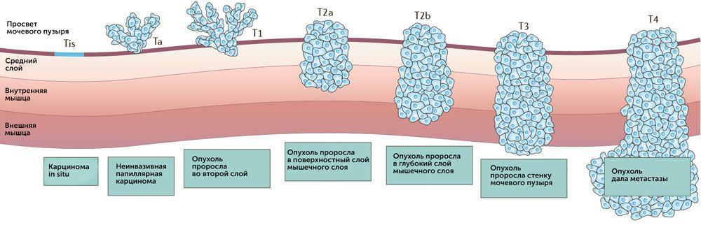 Стадии рака мочевого пузыря