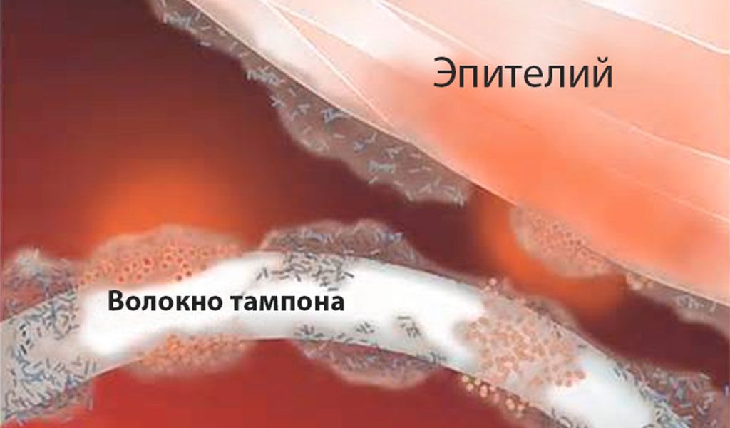 Синдром токсического шока Синдром токсического шока