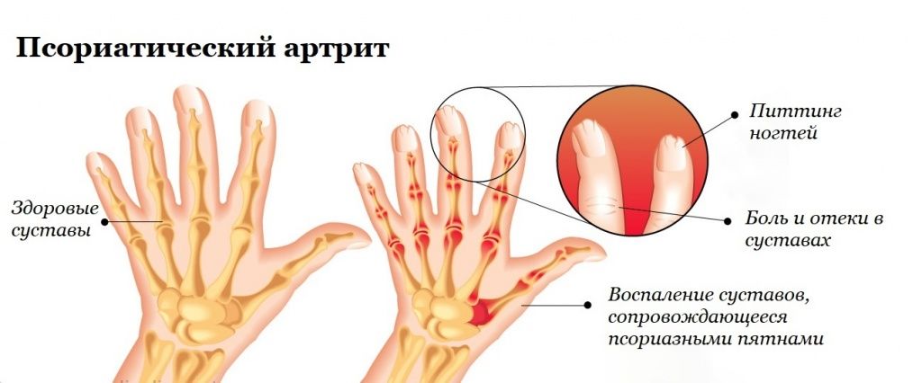 Признаки псориатического артрита