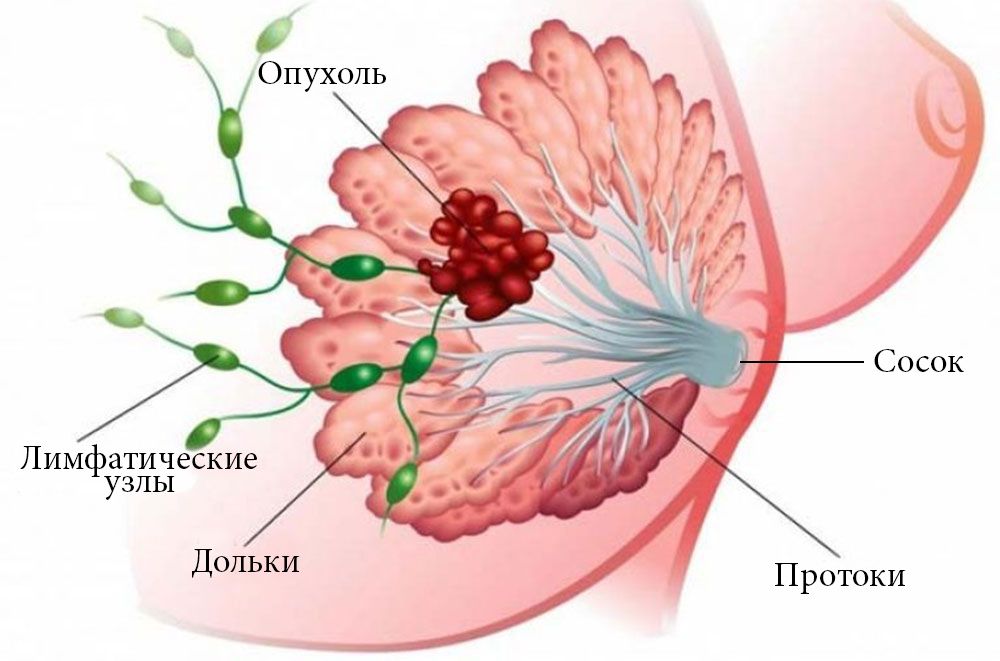 Listovidnaya_opukhol_molochnoy_zhelezy копия.jpg Listovidnaya_opukhol_molochnoy_zhelezy копия.jpg