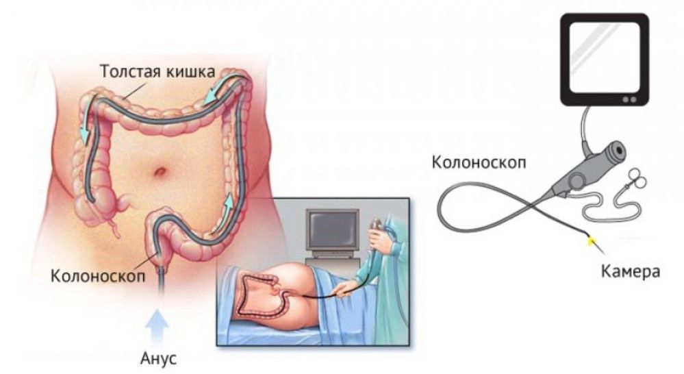Колоноскопия Колоноскопия при синдроме раздраженного кишечника