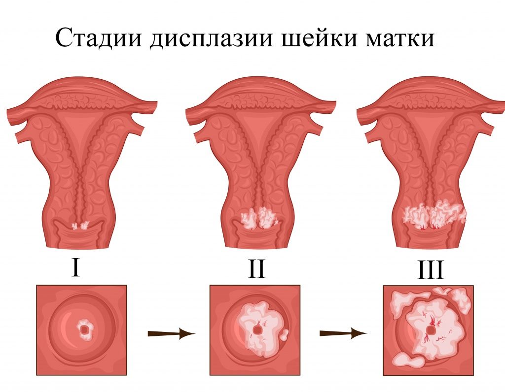 Дисплазия шейки матки