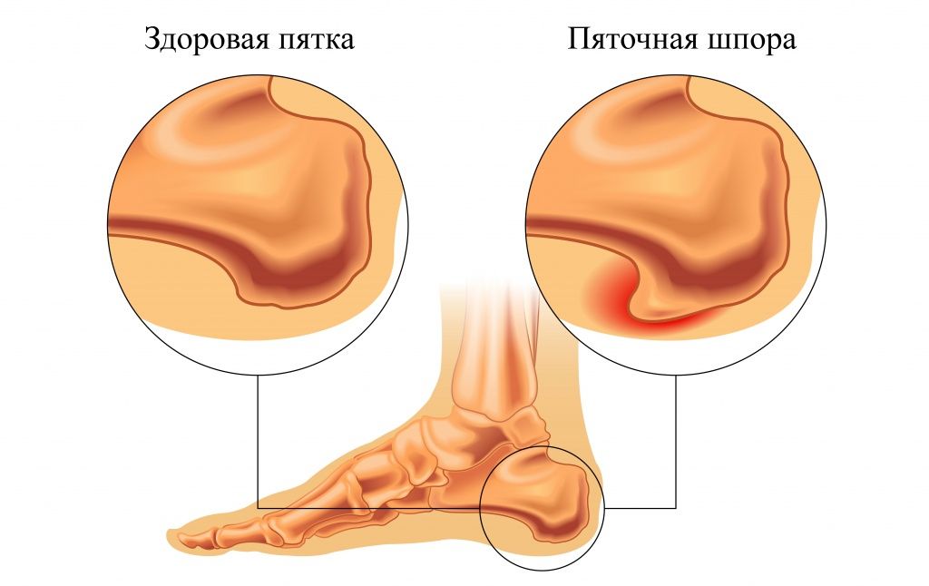 Пяточная шпора