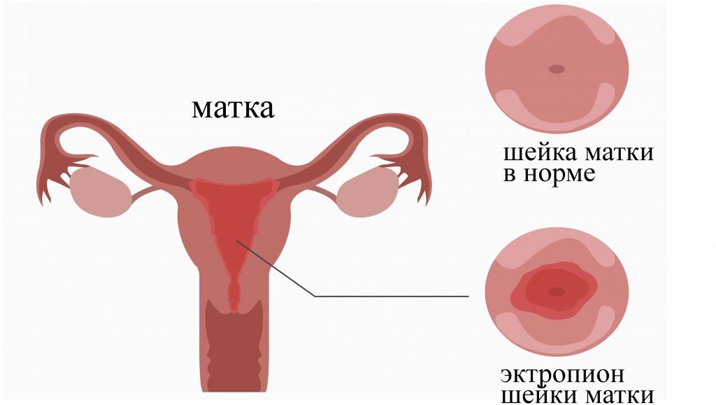 Эктропион ШМ