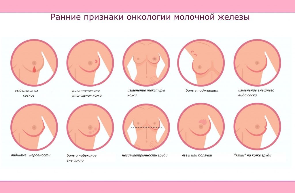 признаки рака молочной железы.jpg признаки рака молочной железы.jpg