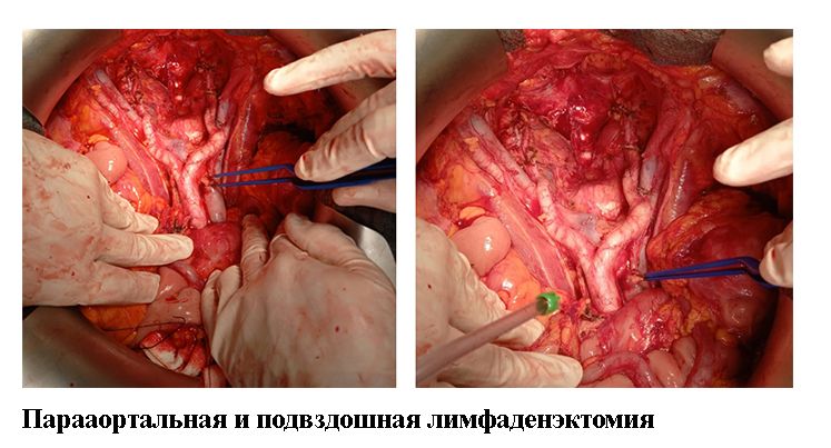 Парааортальная и подвздошная лимфаденэктомия 14.jpg