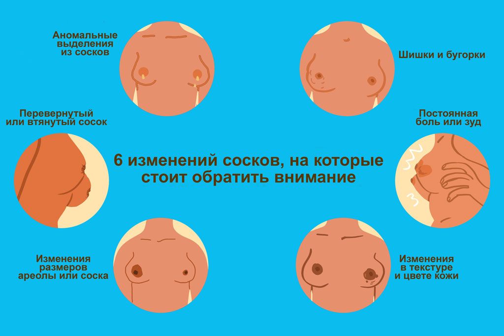 Шесть изменений сосков на которые стоит обратить внимание Шесть изменений сосков на которые стоит обратить внимание