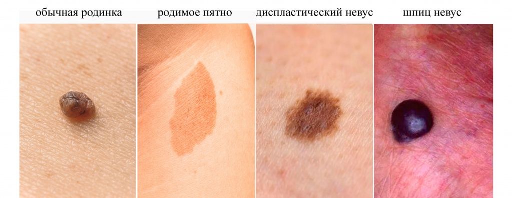 Родинки