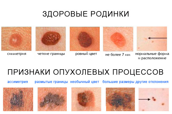 отличие родинки от меланомы