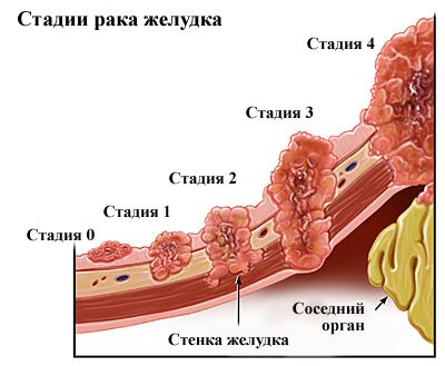 стадии рака желудка