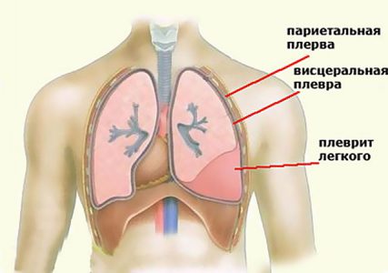 плеврит